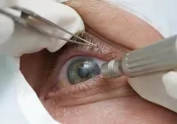 Chega a 13 número de pacientes sem visão após cirurgia de catarata em Salvador imagem