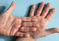 Secretaria de Saúde da Bahia atualiza casos de Mpox no estado em 2026