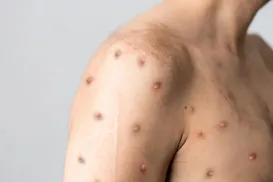 Bahia monitora novo caso suspeito de Mpox em Irecê - Imagem