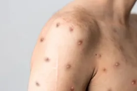 Brasil registra 55 casos de Mpox em 2026 e mantém vigilância reforçada - Imagem