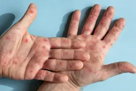 Secretaria de Saúde da Bahia atualiza casos de Mpox no estado em 2026 - Imagem