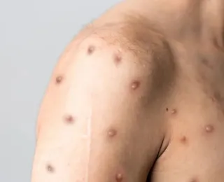 Brasil registra 55 casos de Mpox em 2026 e mantém vigilância reforçada