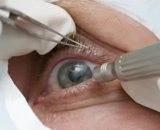 Chega a 13 número de pacientes sem visão após cirurgia de catarata em Salvador