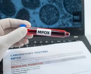 Mpox: número de casos confirmados no Brasil sobe para 140