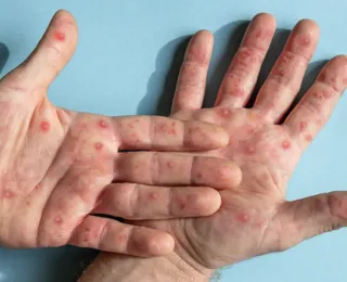 Secretaria de Saúde da Bahia atualiza casos de Mpox no estado em 2026