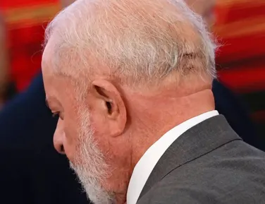 Lula remove câncer de pele; veja os detalhes - Imagem