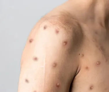 Bahia monitora novo caso suspeito de Mpox em Irecê - Imagem