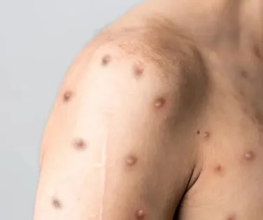 Brasil registra 55 casos de Mpox em 2026 e mantém vigilância reforçada - Imagem