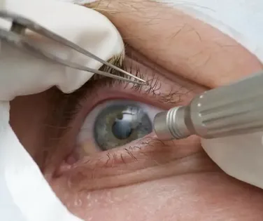 Chega a 13 número de pacientes sem visão após cirurgia de catarata em Salvador - Imagem