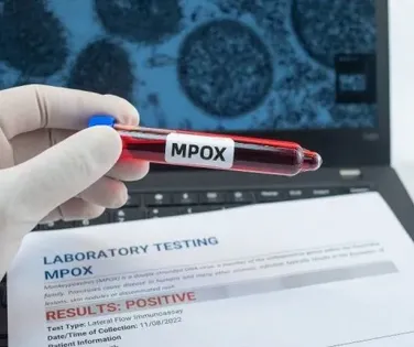 Mpox: número de casos confirmados no Brasil sobe para 140 - Imagem