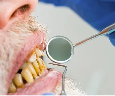 Saiba como a saúde bucal pode influenciar doenças cardíacas - Imagem