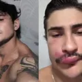 Influenciador é internado após espremer uma espinha na boca imagem