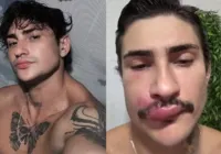 Influenciador é internado após espremer uma espinha na boca
