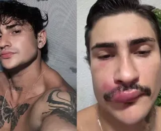 Influenciador é internado após espremer uma espinha na boca