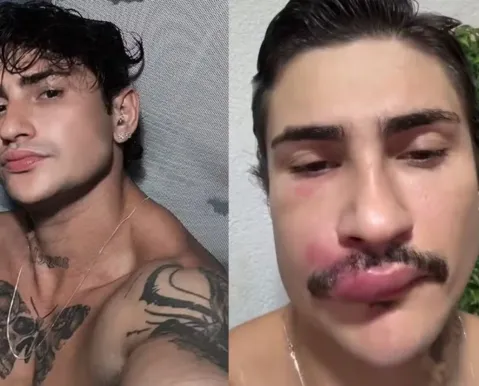 Influenciador é internado após espremer uma espinha na boca - Imagem