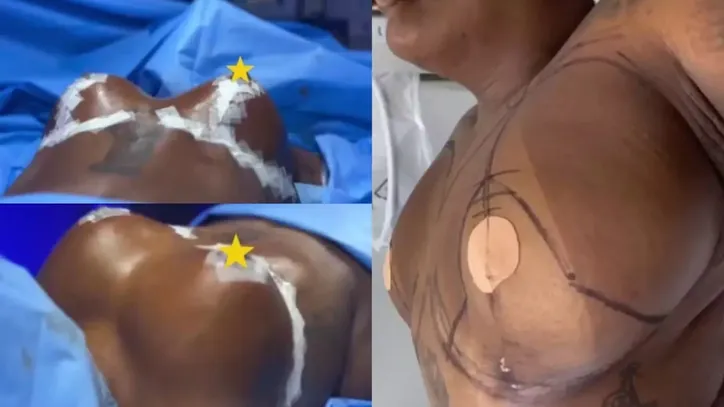 A influencer compartilhou um vídeo com o pré-operatório da mamoplastia redutora