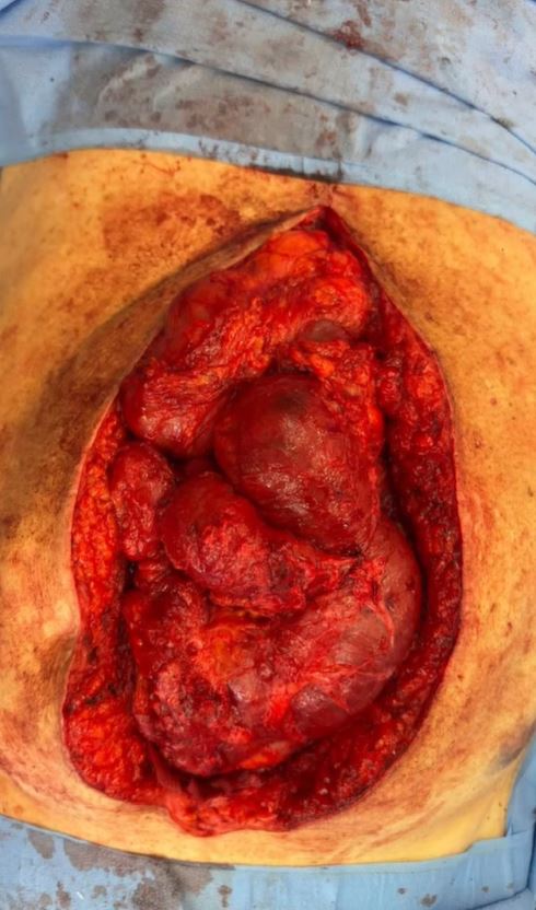 Imagem forte! Bolsonaro publica foto da barriga aberta com intestino à mostra