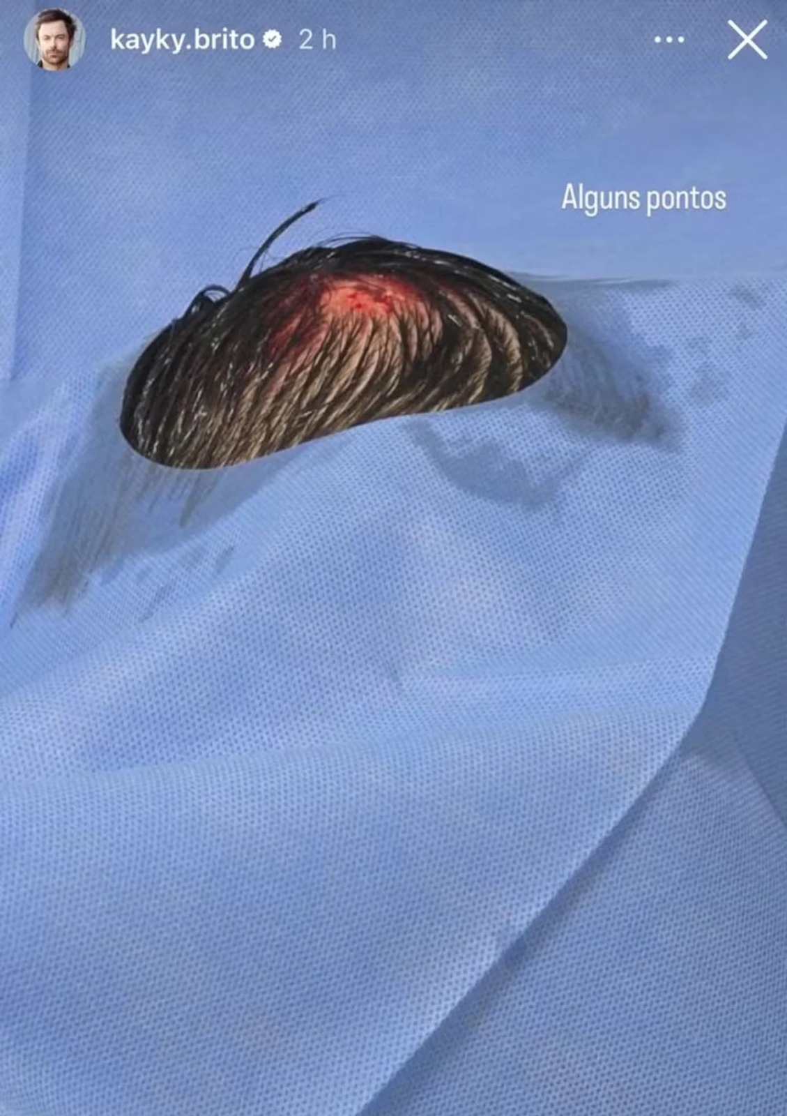 Após atropelamento, Kayky Brito sofre novo acidente