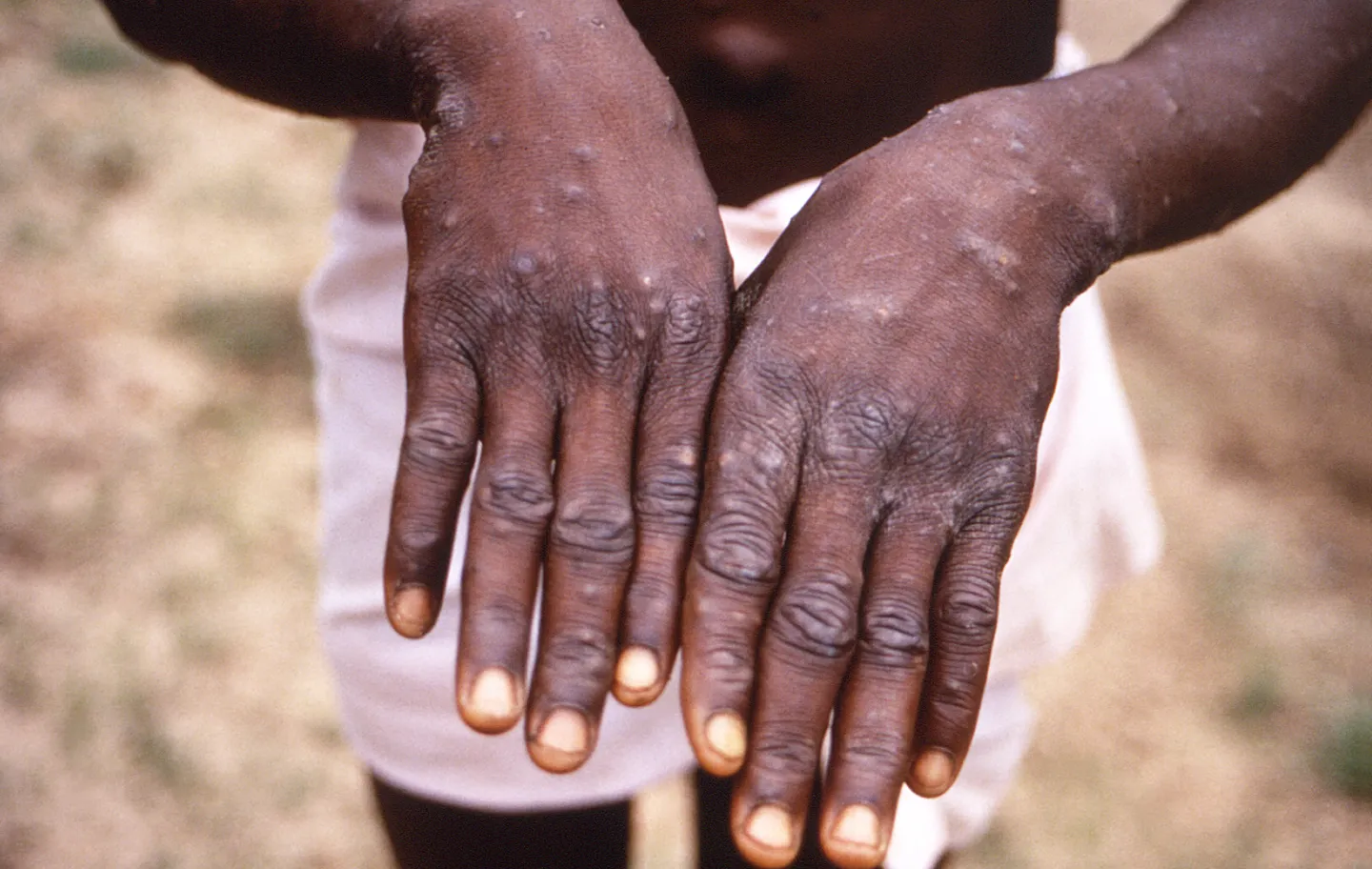 Há décadas, a varíola dos macacos é uma doença endêmica em regiões da África Ocidental e Central