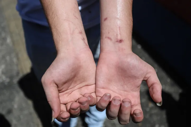 Pulso machucado do aluno Matheus Braga,17, ao tentar se proteger da bomba arremessada no Colégio Estadual Teixeira de Freitas