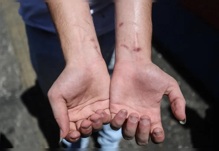 Pulso machucado do aluno Matheus Braga,17, ao tentar se proteger da bomba arremessada no Colégio Estadual Teixeira de Freitas