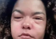 Jeniffer Nascimento faz alerta após reação alérgica por comer lagosta