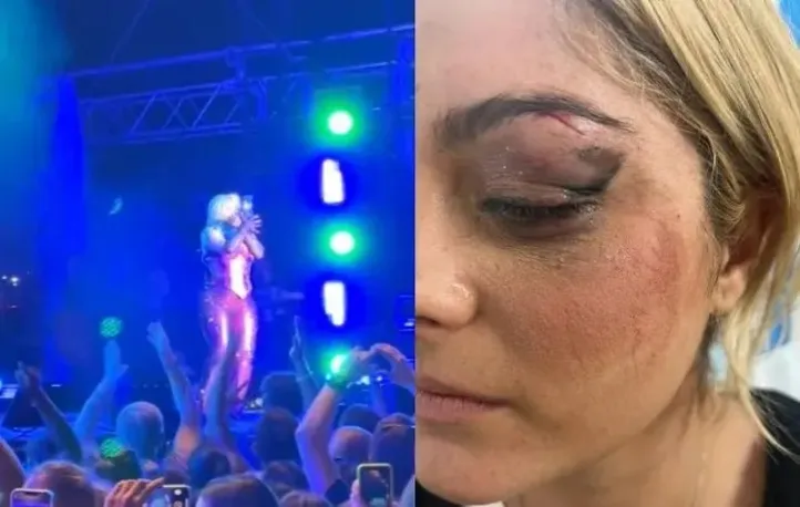 Bebe Rexha foi atingida por no rosto por um telefone