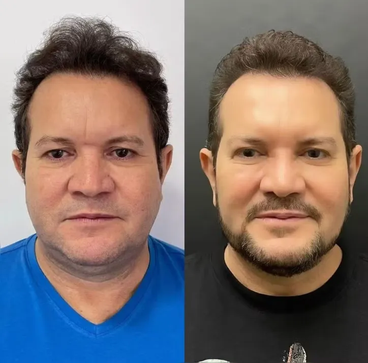 Ximbinha mostra antes e depois de cirurgia facial