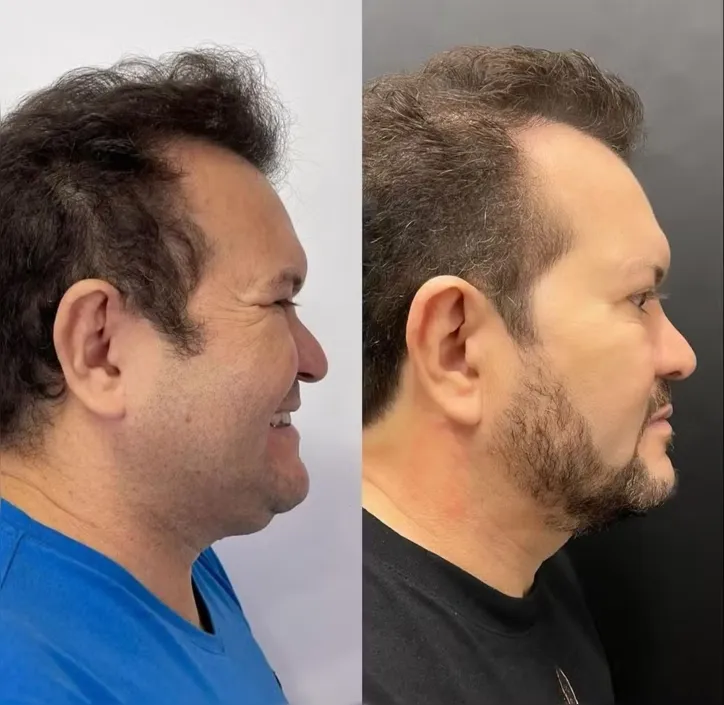 Ximbinha mostra antes e depois de cirurgia facial