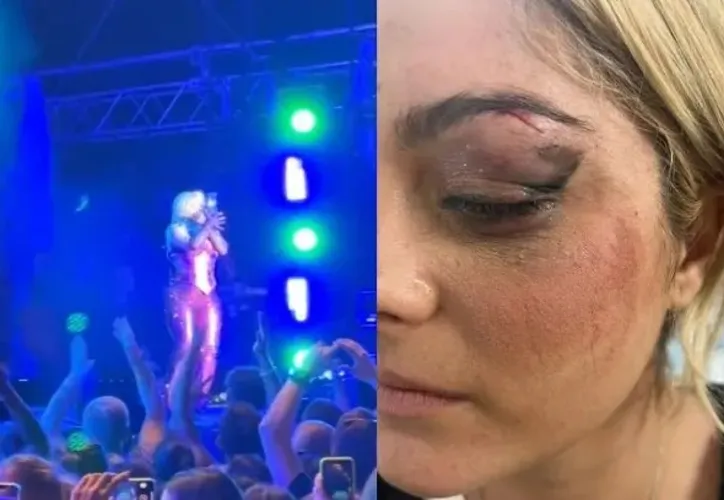 Bebe Rexha foi atingida por no rosto por um telefone