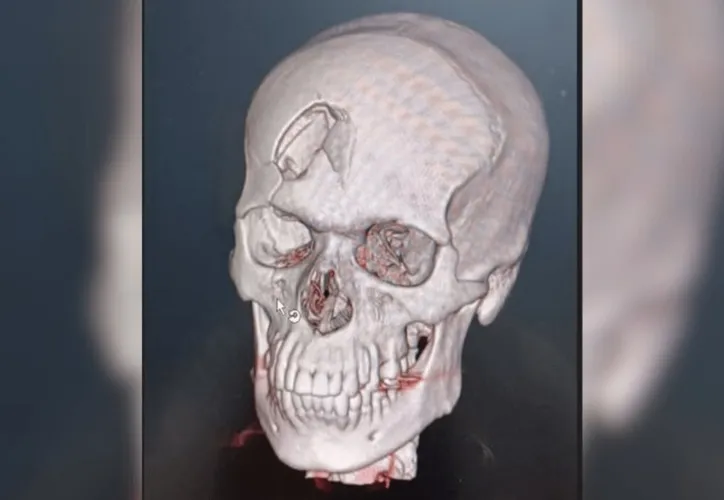 Imagem ilustrativa da imagem Homem de 28 anos tem crânio perfurado por pedaço de madeira em obra