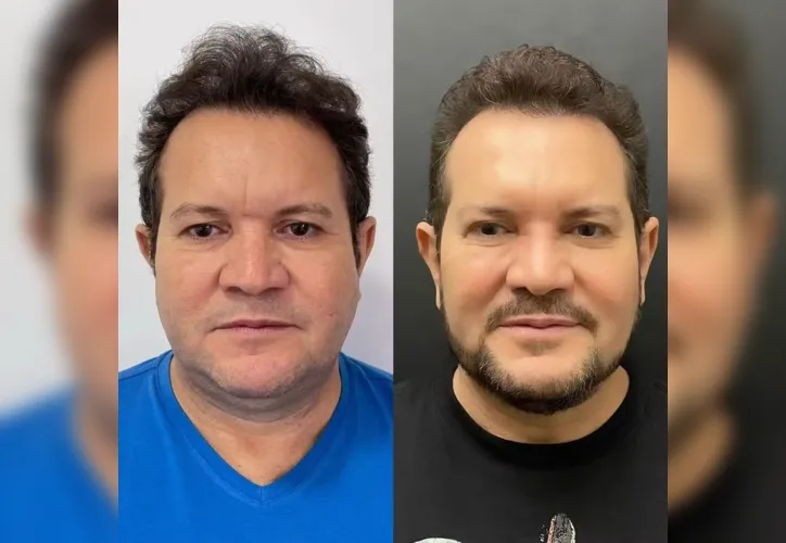 Ximbinha mostra antes e depois de cirurgia facial