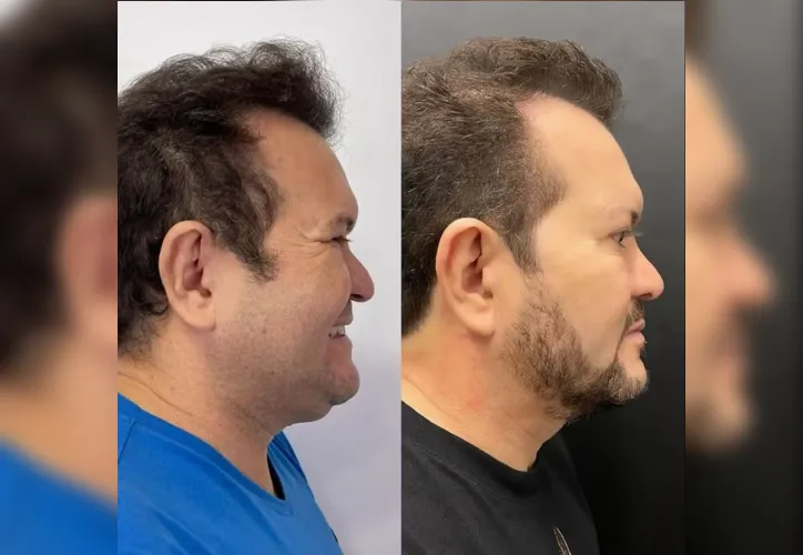 Ximbinha mostra antes e depois de cirurgia facial