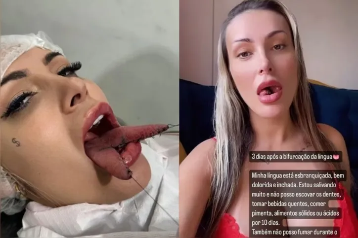 Imagem ilustrativa da imagem Língua de cobra: Saiba quanto custou cirurgia de Andressa Urach