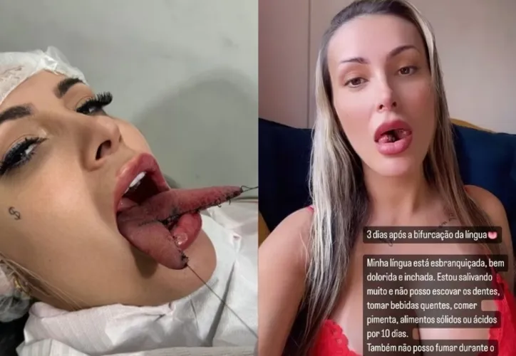 Imagem ilustrativa da imagem Língua de cobra: Saiba quanto custou cirurgia de Andressa Urach