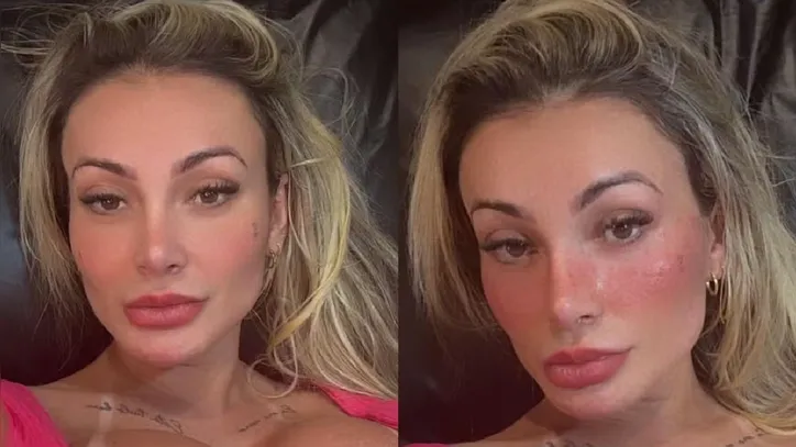 Urach apareceu com sardas