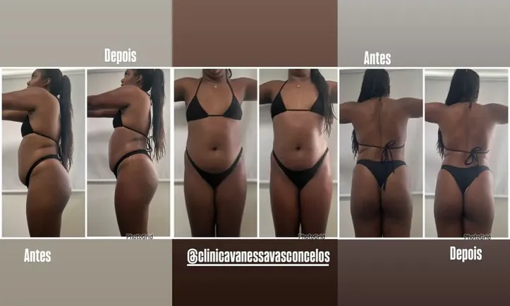 Imagem ilustrativa da imagem Antes e depois: Raquel Brito mostra corpo após procedimento estético