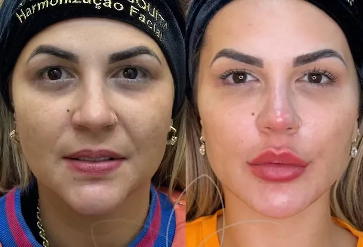 Imagem ilustrativa da imagem Deolane Bezerra passa por nova harmonização facial; confira resultado