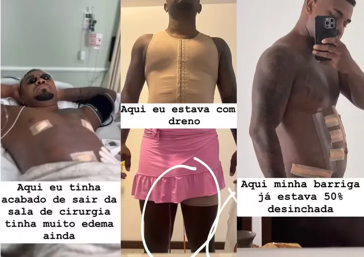 Davi Brito impressiona ao mostrar evolução após procedimento