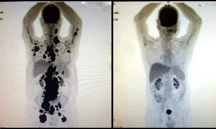 A terapia CAR-T Cell é considerada promissora no tratamento contra o câncer