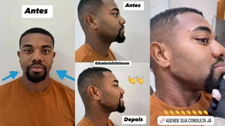 Imagem ilustrativa da imagem Davi Brito faz harmonização facial e resultado impressiona