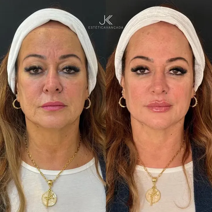 Antes e depois de Nadine