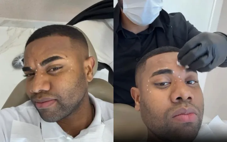 Davi Brito preenchendo o rosto