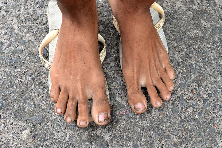 Adolescente mostra os pés ainda com ferimentos