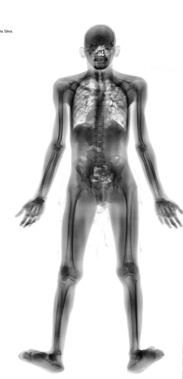 Material foi detectado pelo equipamento de Body Scan corporal