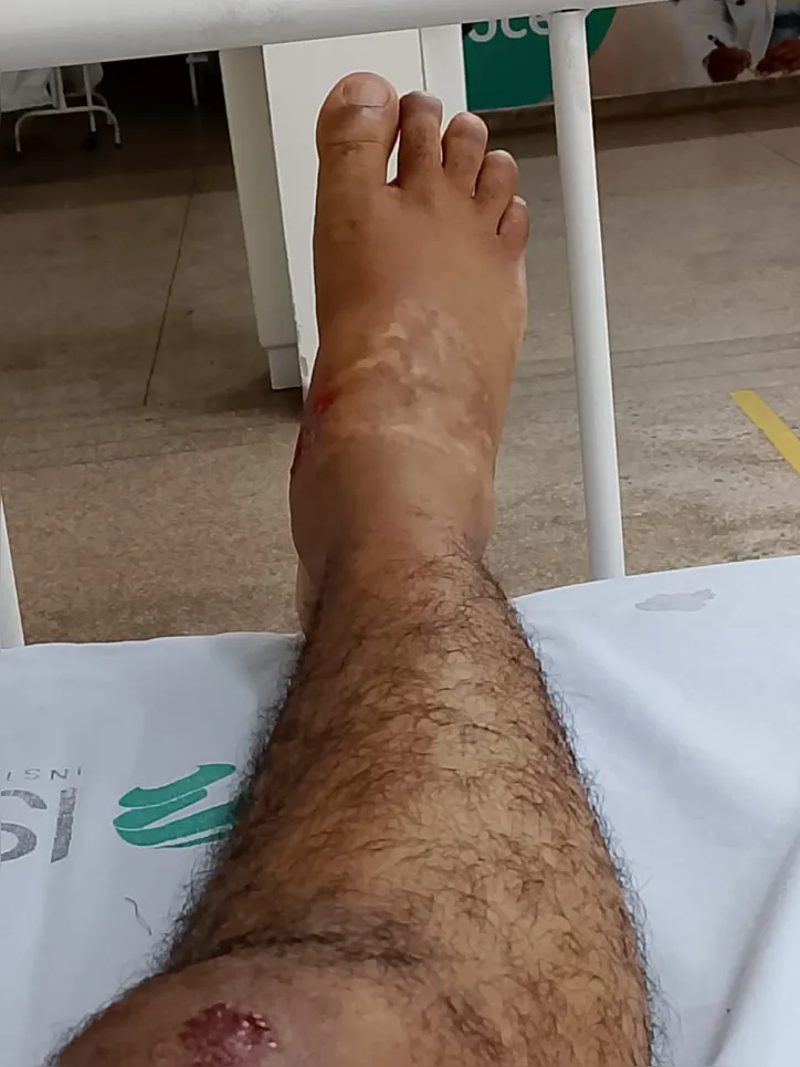 Paciente liberado na UPA teve que passar por cirurgia no HGC.