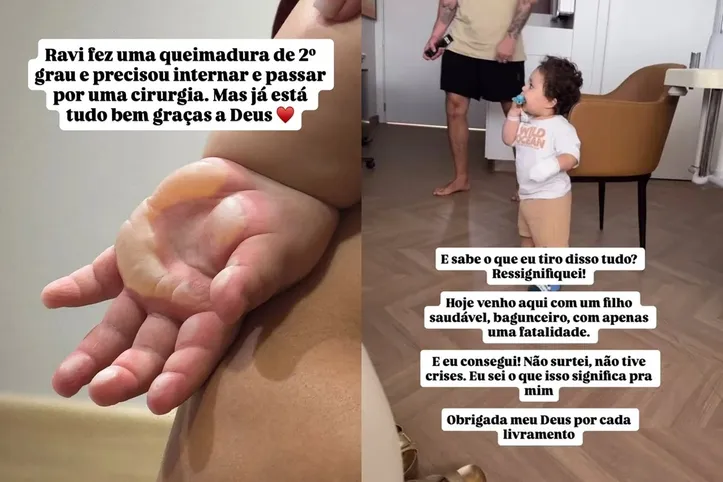 Ravi sofreu uma queimadura de segundo grau na mão