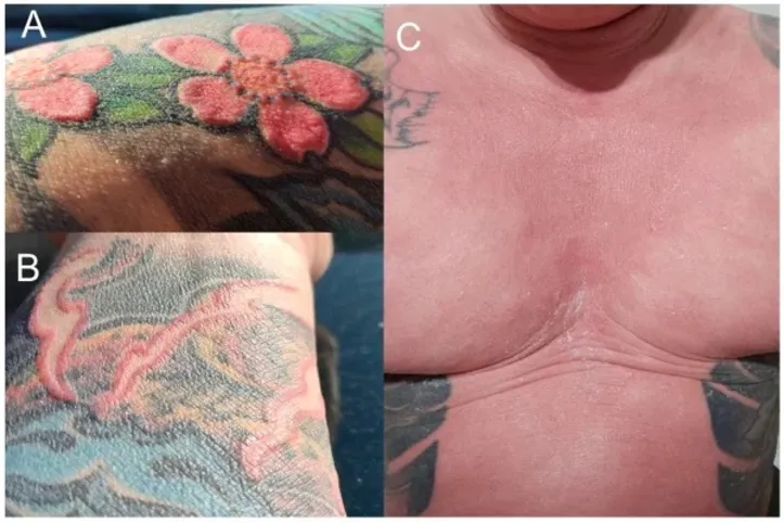 Imagens da irritação da pele do rapaz