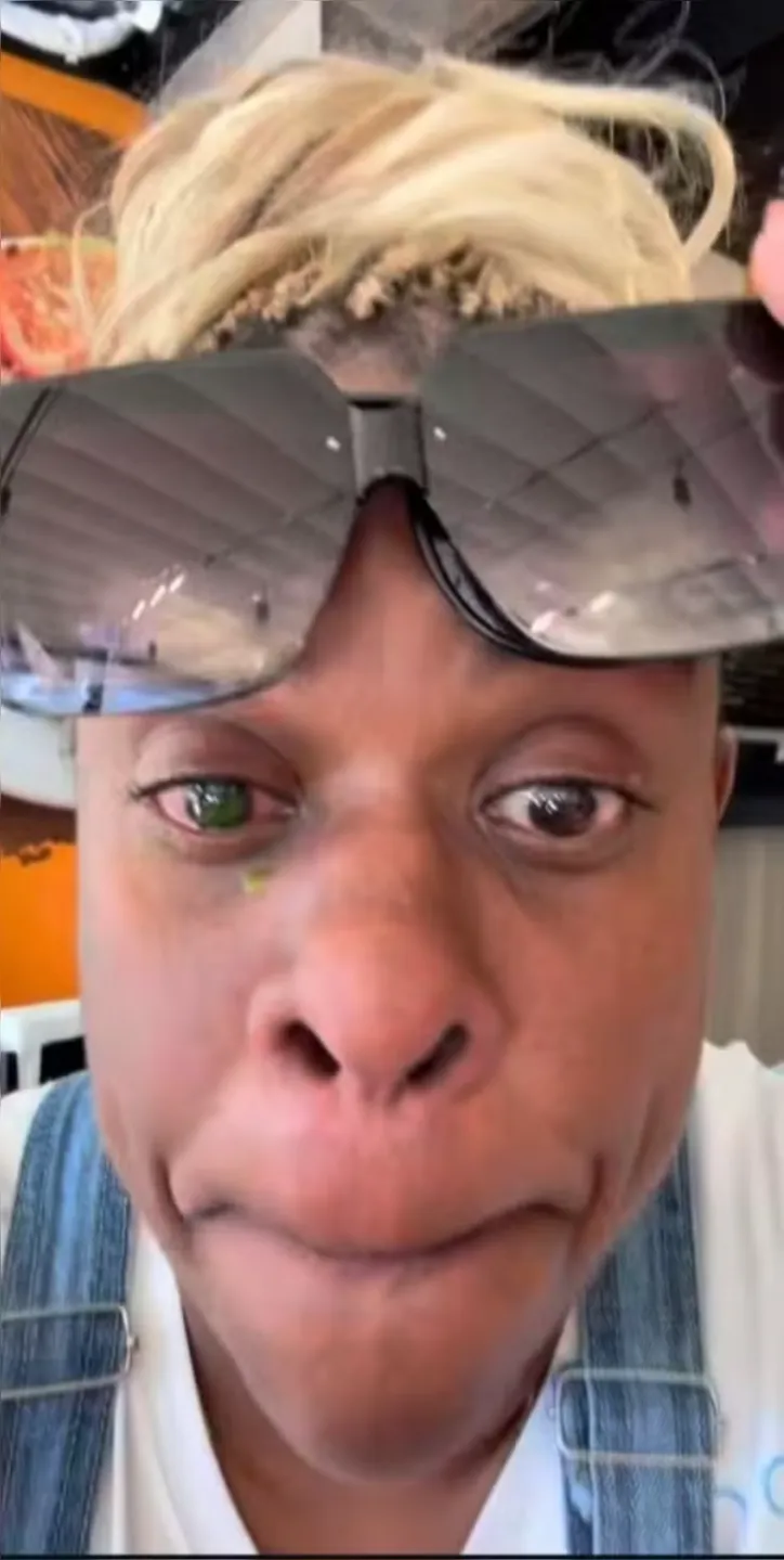 Cacau Protásio, com o olho esverdeado após reação alérgica