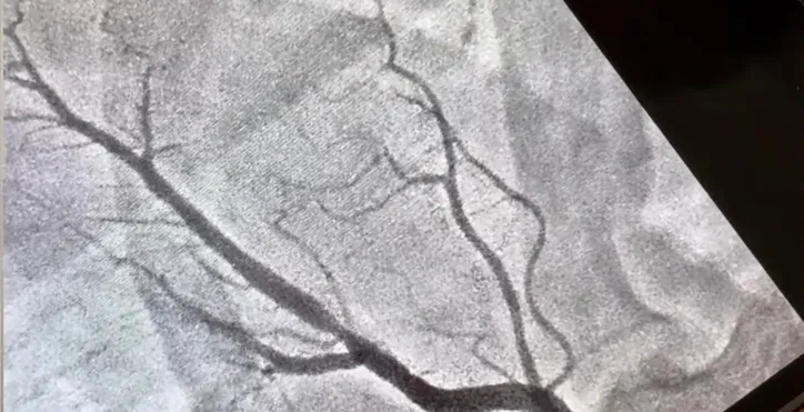 Exame mostra obstrução em artéria do coração